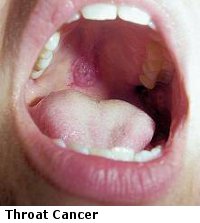 Throat Masses 6