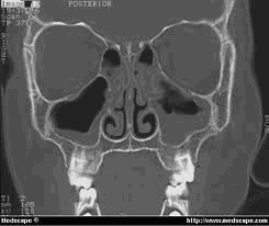 CT Scan with Chronic Sinusitis